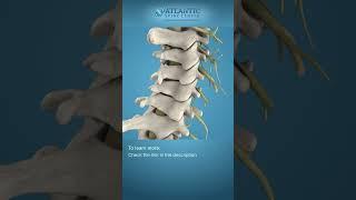 What is Cervical Disc Herniation? #shorts