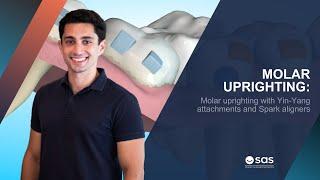 Molar uprighting with Yin-Yang attachments and Spark aligners | SAS