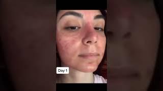 SKIN AFTER MICRONEEDLING #shorts