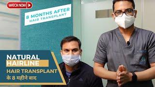 Natural Hairline with 2200 grafts | Hair Transplant Results 8 महीने बाद