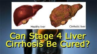 Can Stage 4 Liver Cirrhosis Be Cured?