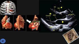 Echocardiographic Anatomy; Part 1: PLAX (Parasternal Long Axis)