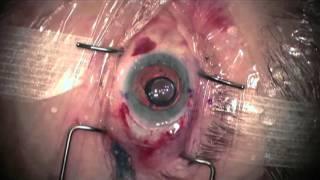 Implantable Miniature Telescope Surgical Procedure, Samuel Masket, MD