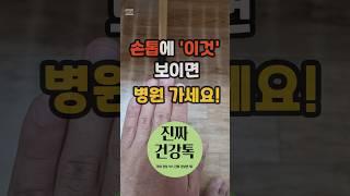 손톱에 '이것' 보이면 당장 병원으로 달려가세요. #건강 #건강정보 #손톱