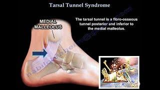 Tarsal Tunnel Syndrome - Everything You Need To Know - Dr. Nabil Ebraheim