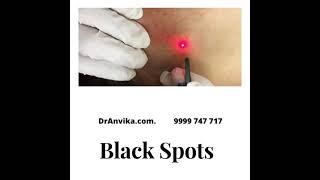 Black Spots Removal with Laser by Dr.Anvika // DrAnvika.com // 9999 747 717