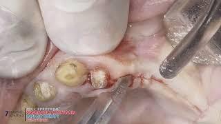 Zygomatic And Pterygoid Implant Course 7 Reasons Why You Should Attend