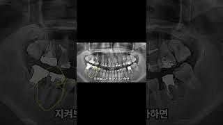 아파서 치과 갔는데, 신경치료 권유 받았어요.  #교정중생기는 #프라임S치과