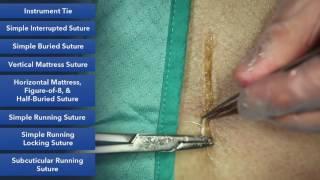 Subcuticular Running Suture   Suture Techniques