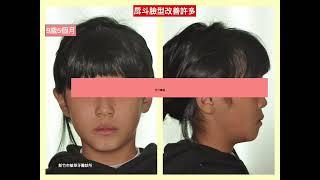 “12歲以前的早期矯正治療-早期戽斗治療（三）”