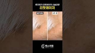 리팟레이저 시술과정 #리팟레이저 #흑자제거 #시술과정