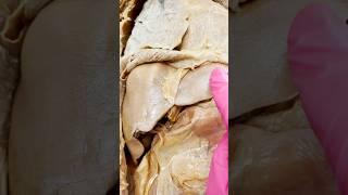 Cancerous Liver vs Healthy Liver