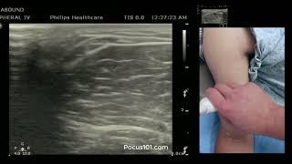 Mapping out Brachial, Cephalic, and Basilic Veins