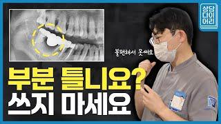 상악동염이 있으면 임플란트 불가능? 상악동 이식부터 점검하세요