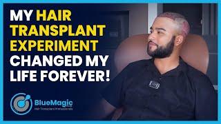 My Hair Transplant EXPERIMENT Changed My Life Forever!