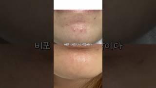 턱드름 순삭 패치 알려드림