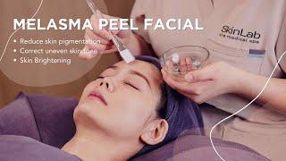 Lighten skin pigmentation with Melasma Peel Facial