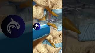 See how a TLIF relieves back pain and restores spinal stability with a 3D Animation.