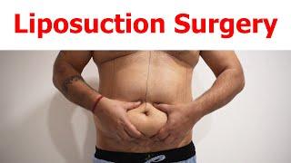 Liposuction | 360 Abdominal Liposuction | liposuction in delhi | Dezire Clinic