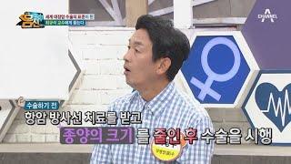 세계 대장암 수술의 표준! 최규석 교수님의 대장암 수술 현장 대공개 | 나는 몸신이다 344 회