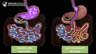 Шунтирование желудка (гастрошунтирование)