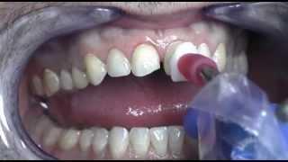 Prepless Veneers Procedure at Cosmetic Dental Associates San Antonio, TX Dental Practice