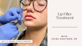 Lip Filler Treatment | Dr. J. J. Wendel Plastic Surgery