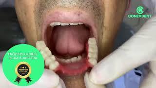 PRÓTESIS DENTAL  parcial flexible  alta  estética (PREMIUM)999