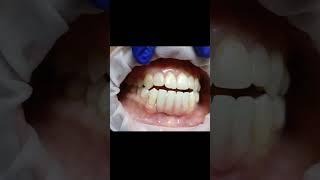 HIPC bridge for lower 4 incisors and 3 basal implants fixing video! ##shorts