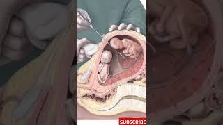 Amniocentesis Explained: The Procedure, Risks & Benefits