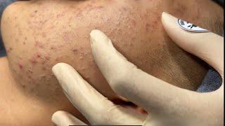 Blackheads & Whiteheads Removal New 2024 | Acne Treatment With  Bo Nguyễn Spa 027