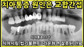 치아통증 원인은 교합간섭. 치아시림, 씹기불편 상황에서 크라운하면 잘못된 진료. 치아통증원인도 모르는 치과많음. 치아통증01강 DentiTube2023.07.18