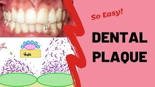 Dental Plaque | Types and Formation