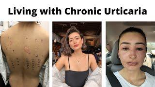 Living with Chronic Urticaria - My First Flareup + Q&A | Autoimmune Chronic Hives | Chronic Illness