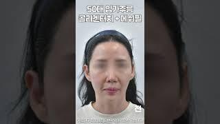 50대 마리오넷주름, 입가처짐 한달 후 변화 #콜라겐주사 #shorts
