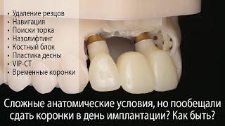 Разбор операции: имплантация, навигация, назолифтинг, забор костного блока, VIP-CT, коронки сразу