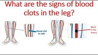 What are the signs of blood clots in the leg?