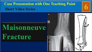 Maisonneuve Fracture ,Case Presentation with One Teaching Point