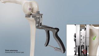 Mathys: balanSys UNI Surgical technique – Ligament Tensor