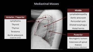 How to Interpret a Chest X-Ray (Lesson 5 - Cardiac Silhouette and Mediastinum)