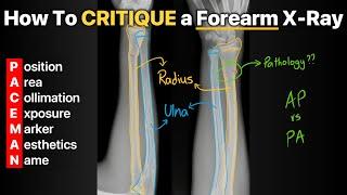 How To Critique a Forearm X Ray!