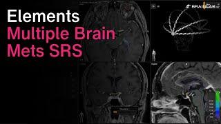 Radiosurgery Solution for Treatment of Multiple Brain Metastases - Multiple Brain Mets SRS