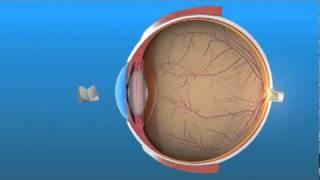 Presbyopia