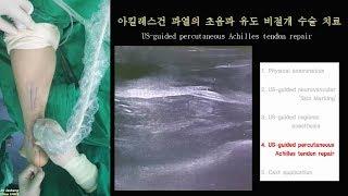 221.(의사용.Achilles rupture.통합본) Kang’s method: US-guided percut repair. A to Z [강찬.정형외과.충남대병원.Chan]