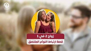 زواج 2 في 1.. قصة ارتباط التوأم الملتصق