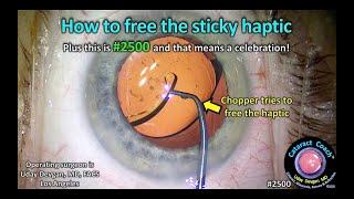 CataractCoach™ 2500: how to free the sticky haptic from the optic