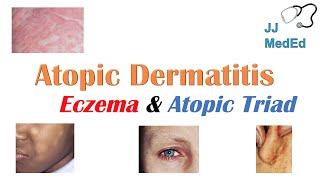 Eczema (Atopic Dermatitis) | Atopic Triad, Triggers, Who gets it, Why does it happen, & Treatment