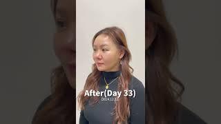 안면거상 실제 수술 후기! #안면거상술