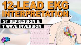 Myocardial Ischemia - ST Depression & T Wave Inversion - 12-lead EKG