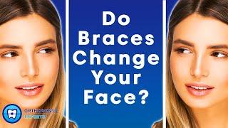 Do Braces Change Your Face? | The Impact Of Braces On Your Jawline & Face Shape